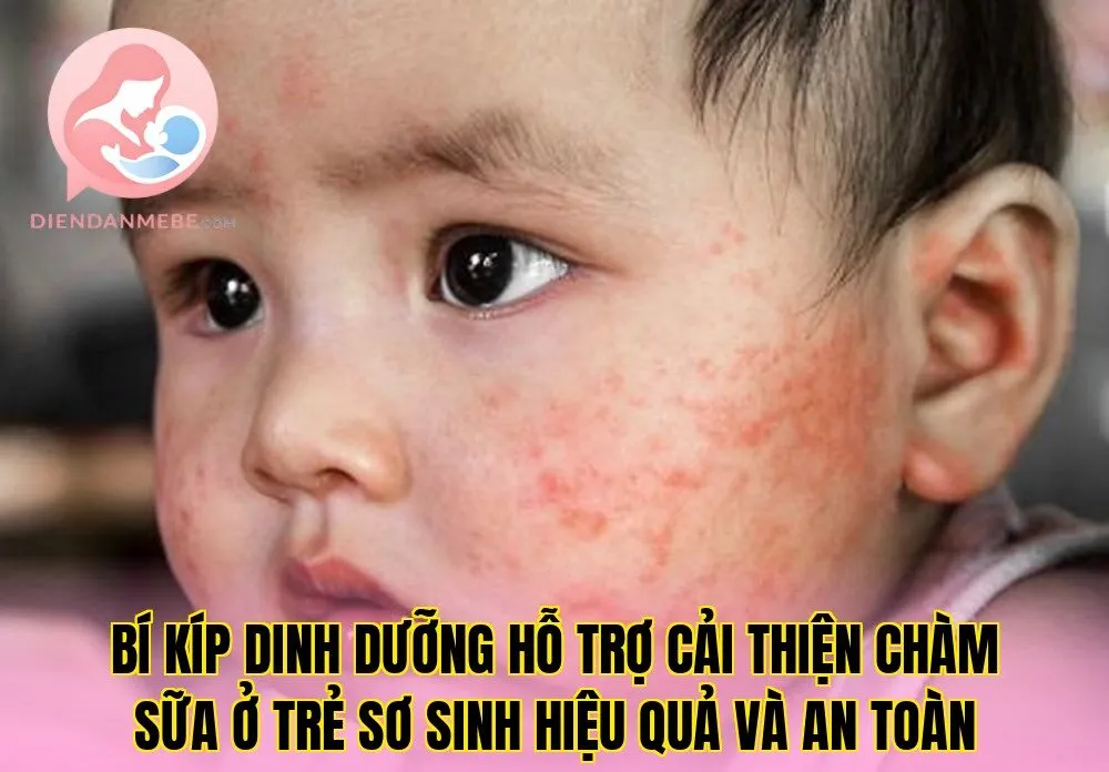 Bí kíp dinh dưỡng hỗ trợ cải thiện chàm sữa ở trẻ sơ sinh hiệu quả và an toàn