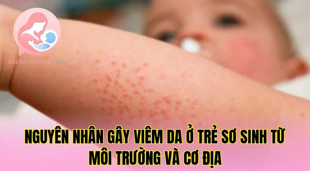 Nguyên nhân gây viêm da ở trẻ sơ sinh từ môi trường và cơ địa