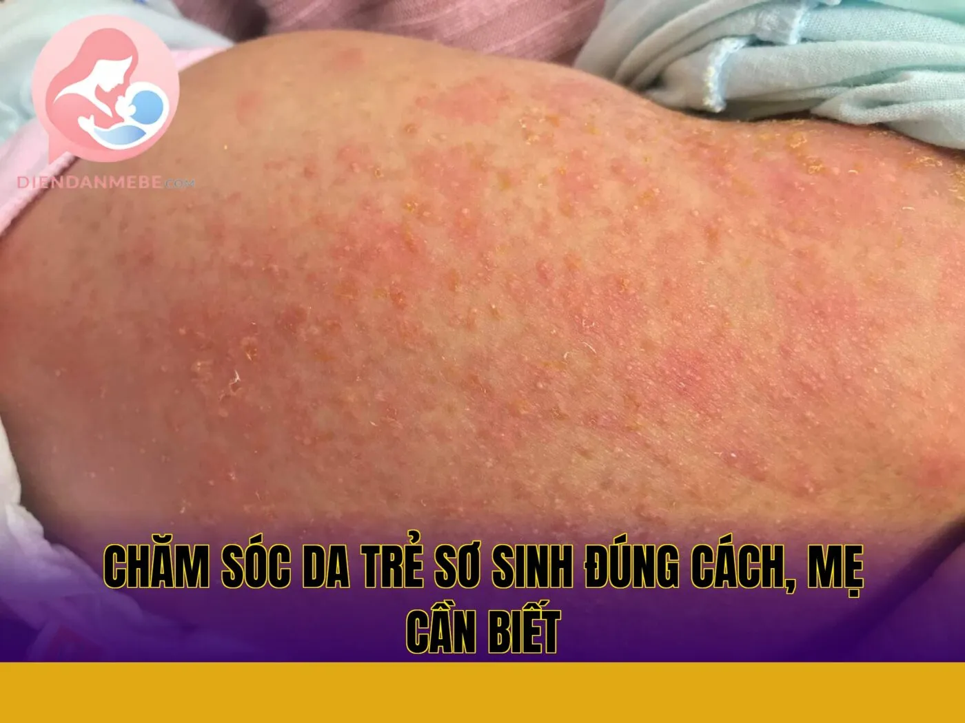 Chăm sóc da trẻ sơ sinh đúng cách, mẹ cần biết