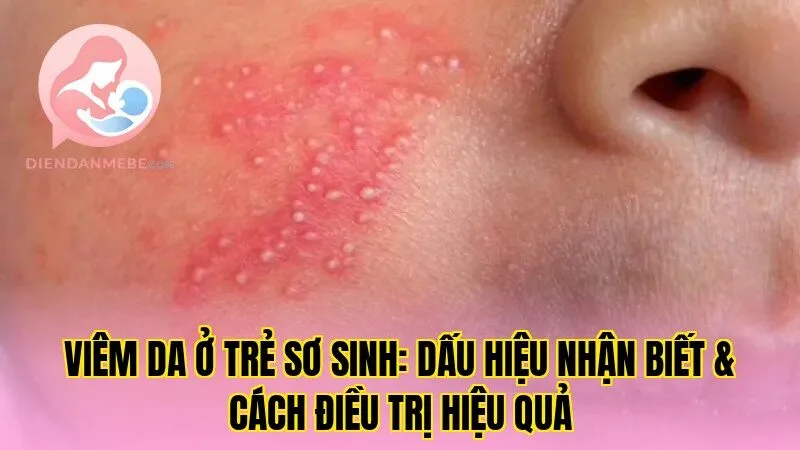 Viêm da ở trẻ sơ sinh: Dấu hiệu nhận biết & cách điều trị hiệu quả