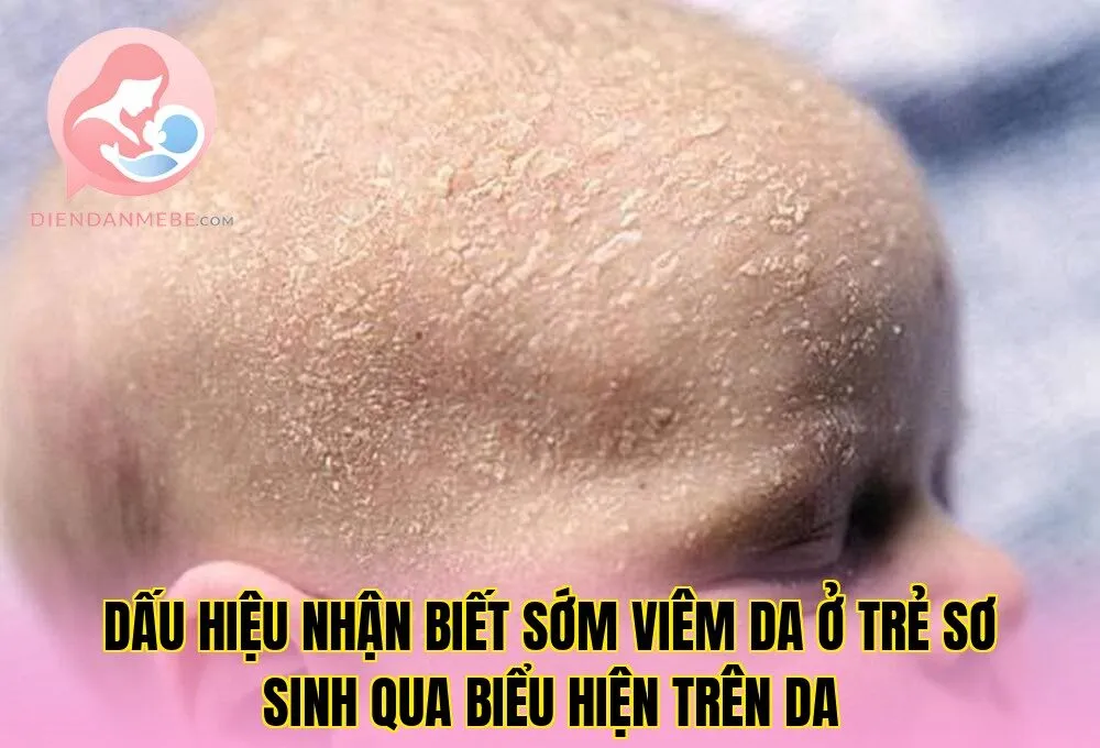 Dấu hiệu nhận biết sớm viêm da ở trẻ sơ sinh qua biểu hiện trên da