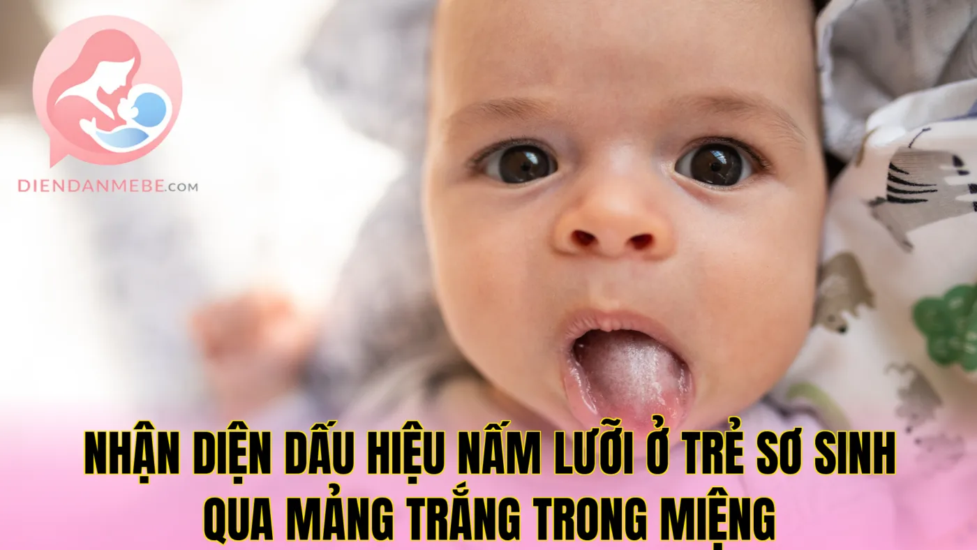 Nhận diện dấu hiệu nấm lưỡi ở trẻ sơ sinh qua mảng trắng trong miệng