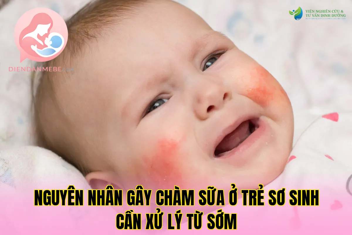 Nguyên nhân gây chàm sữa ở trẻ sơ sinh cần xử lý từ sớm