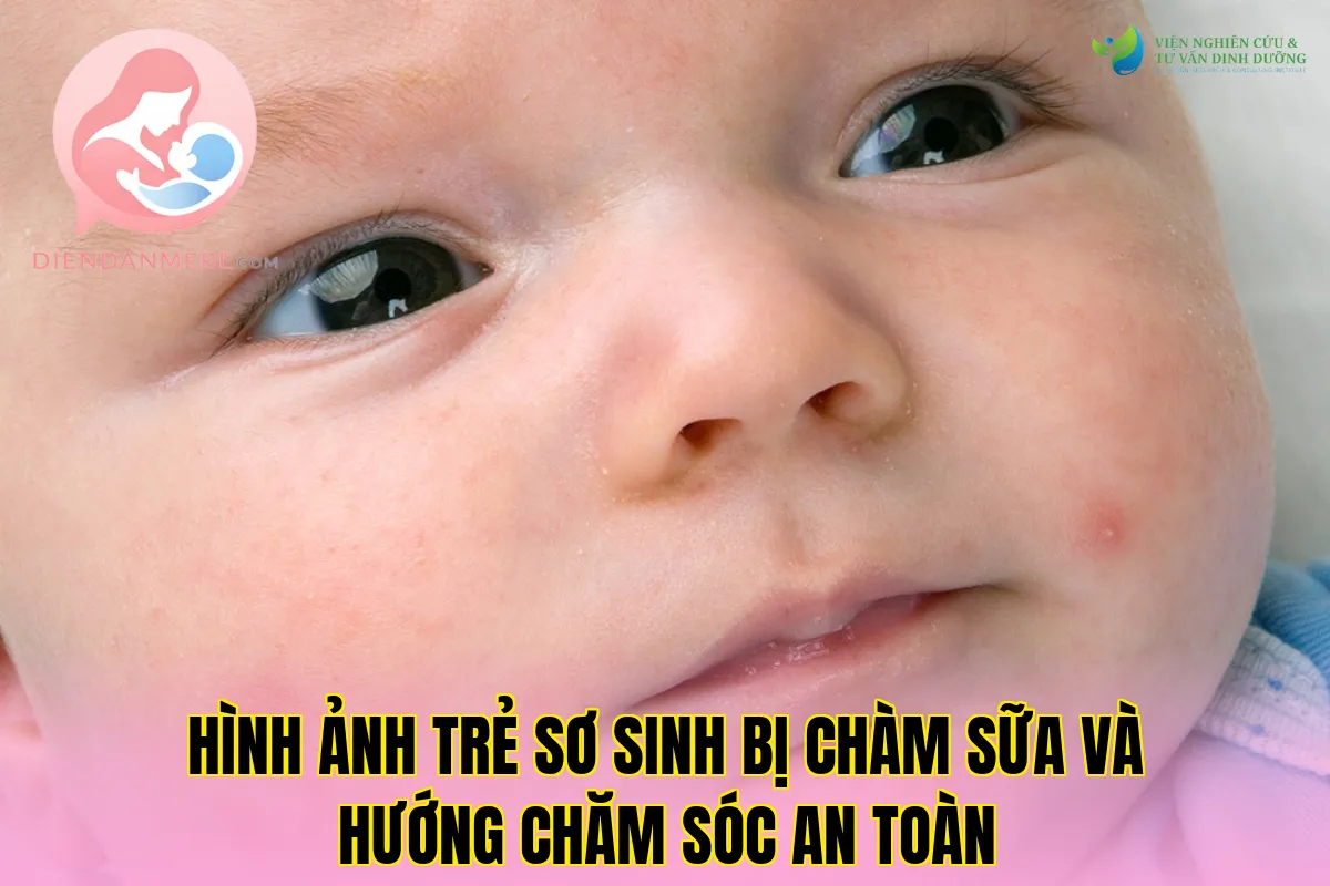 Hình ảnh trẻ sơ sinh bị chàm sữa và hướng chăm sóc an toàn