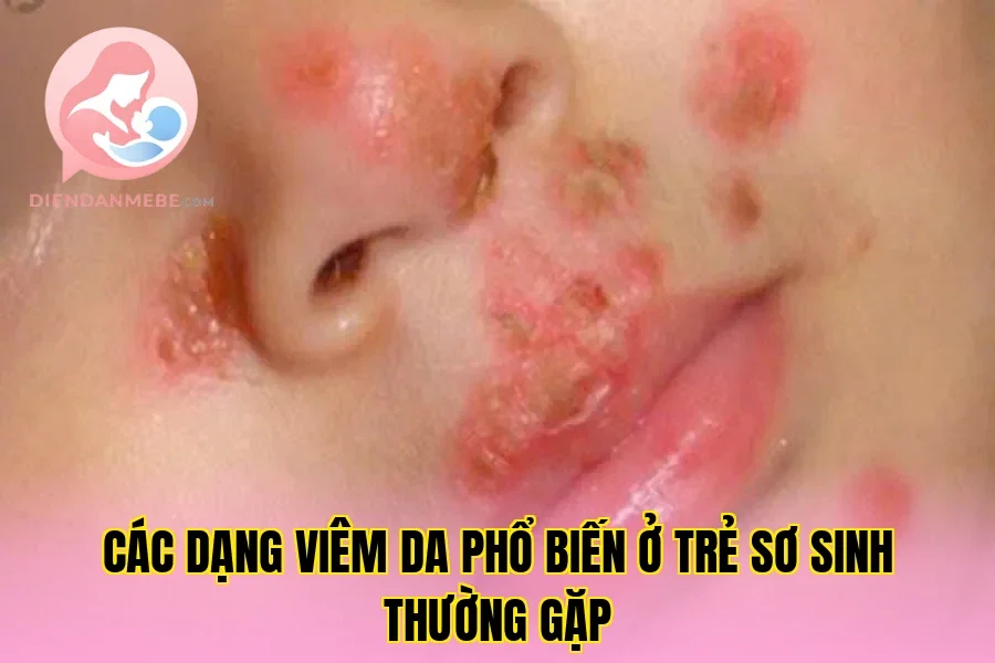 Các dạng viêm da phổ biến ở trẻ sơ sinh thường gặp
