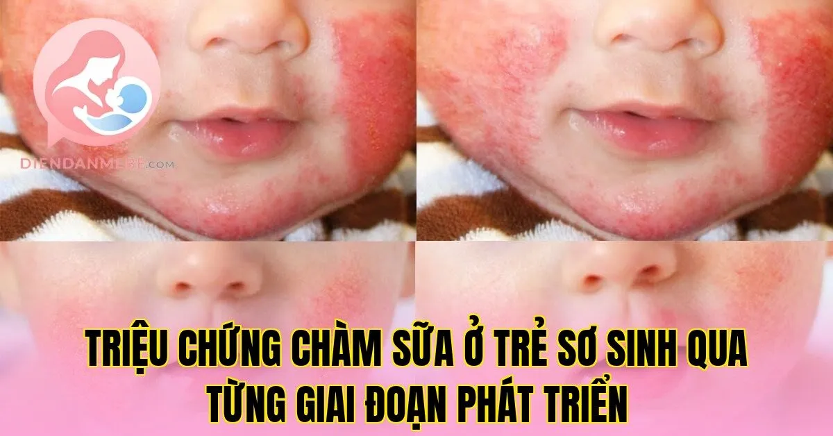 Triệu chứng chàm sữa ở trẻ sơ sinh qua từng giai đoạn phát triển