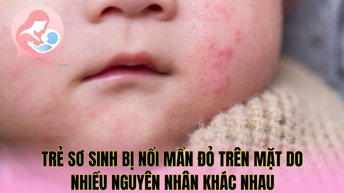 Trẻ sơ sinh bị nổi mẩn đỏ trên mặt do nhiều nguyên nhân khác nhau