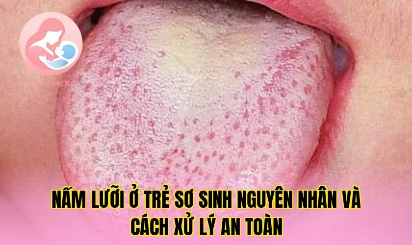 Nấm Lưỡi Ở Trẻ Sơ Sinh Nguyên Nhân Và Cách Xử Lý An Toàn