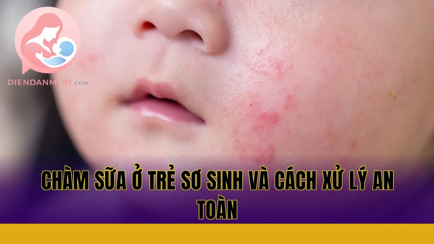 Chàm sữa ở trẻ sơ sinh và cách xử lý an toàn
