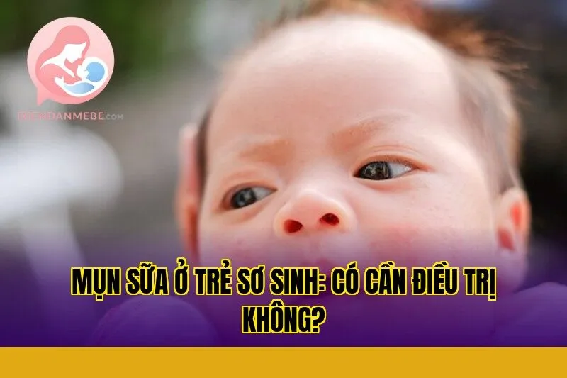 Mụn sữa ở trẻ sơ sinh: Có cần điều trị không?