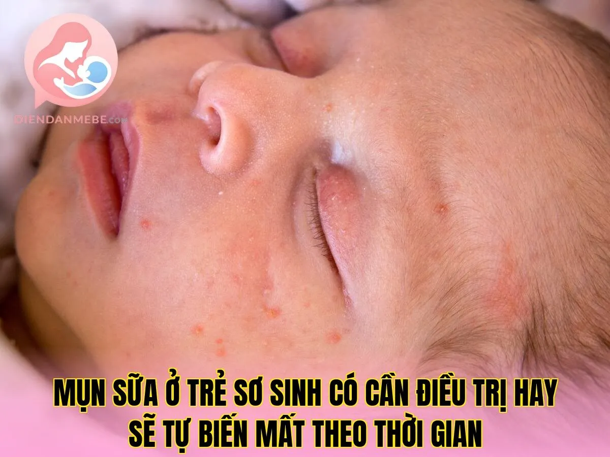 Mụn sữa ở trẻ sơ sinh có cần điều trị hay sẽ tự biến mất theo thời gian