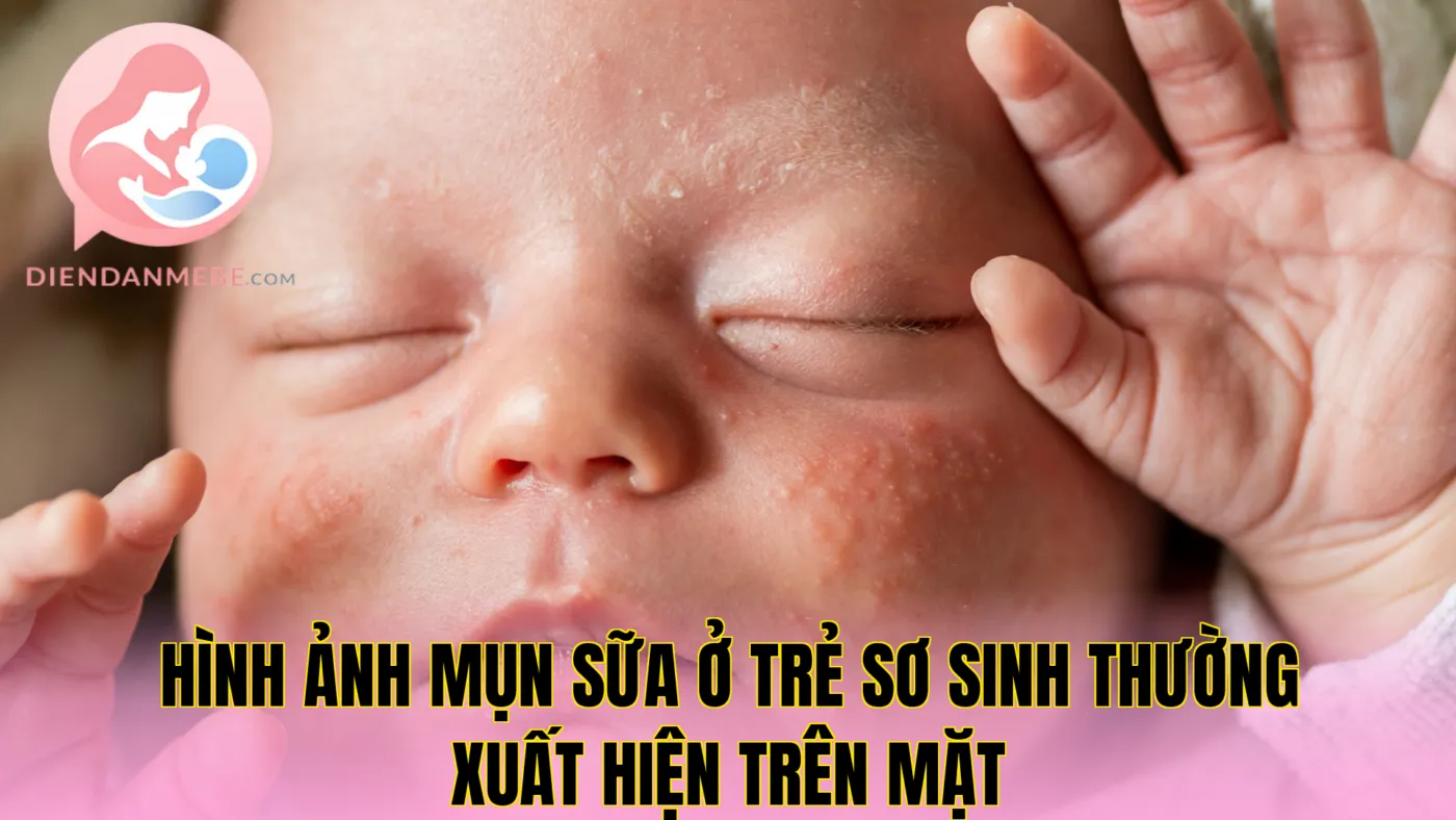 Hình ảnh mụn sữa ở trẻ sơ sinh thường xuất hiện trên mặt