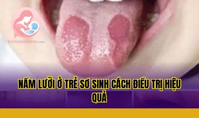 Nấm lưỡi ở trẻ sơ sinh cách điều trị hiệu quả