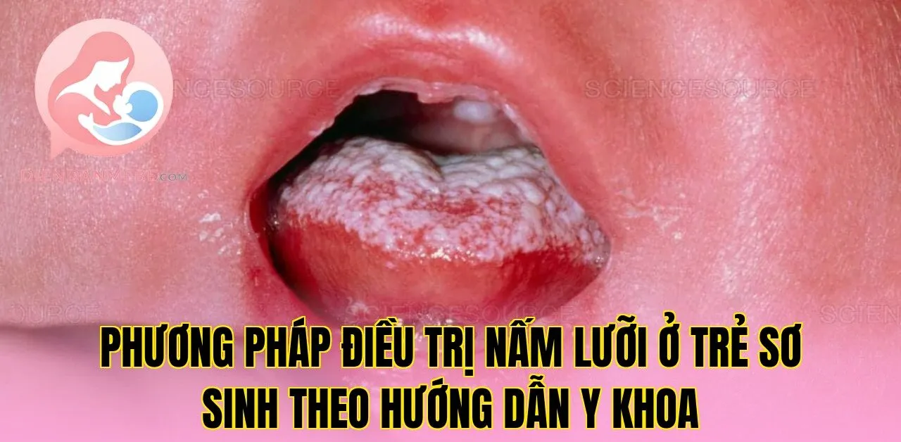Phương pháp điều trị nấm lưỡi ở trẻ sơ sinh theo hướng dẫn y khoa