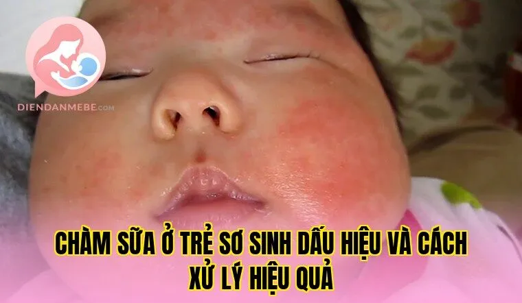 Chàm Sữa Ở Trẻ Sơ Sinh Dấu Hiệu Và Cách Xử Lý Hiệu Quả