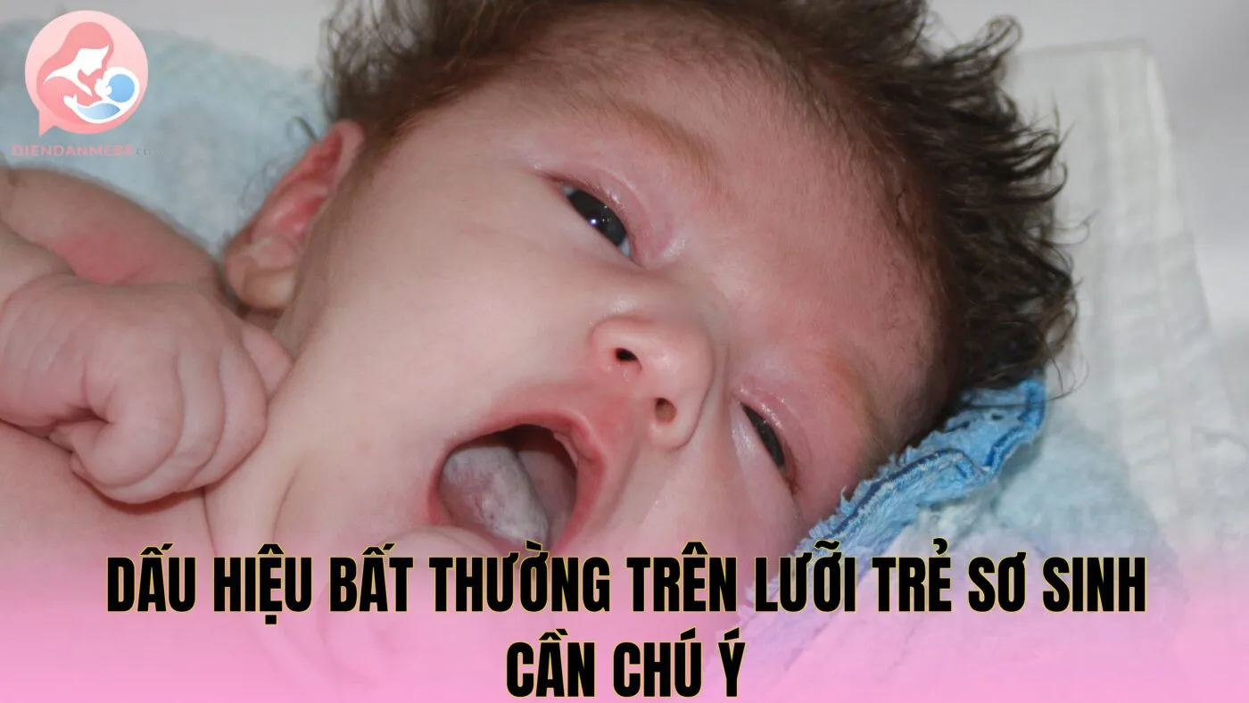 Dấu hiệu bất thường trên lưỡi trẻ sơ sinh cần chú ý
