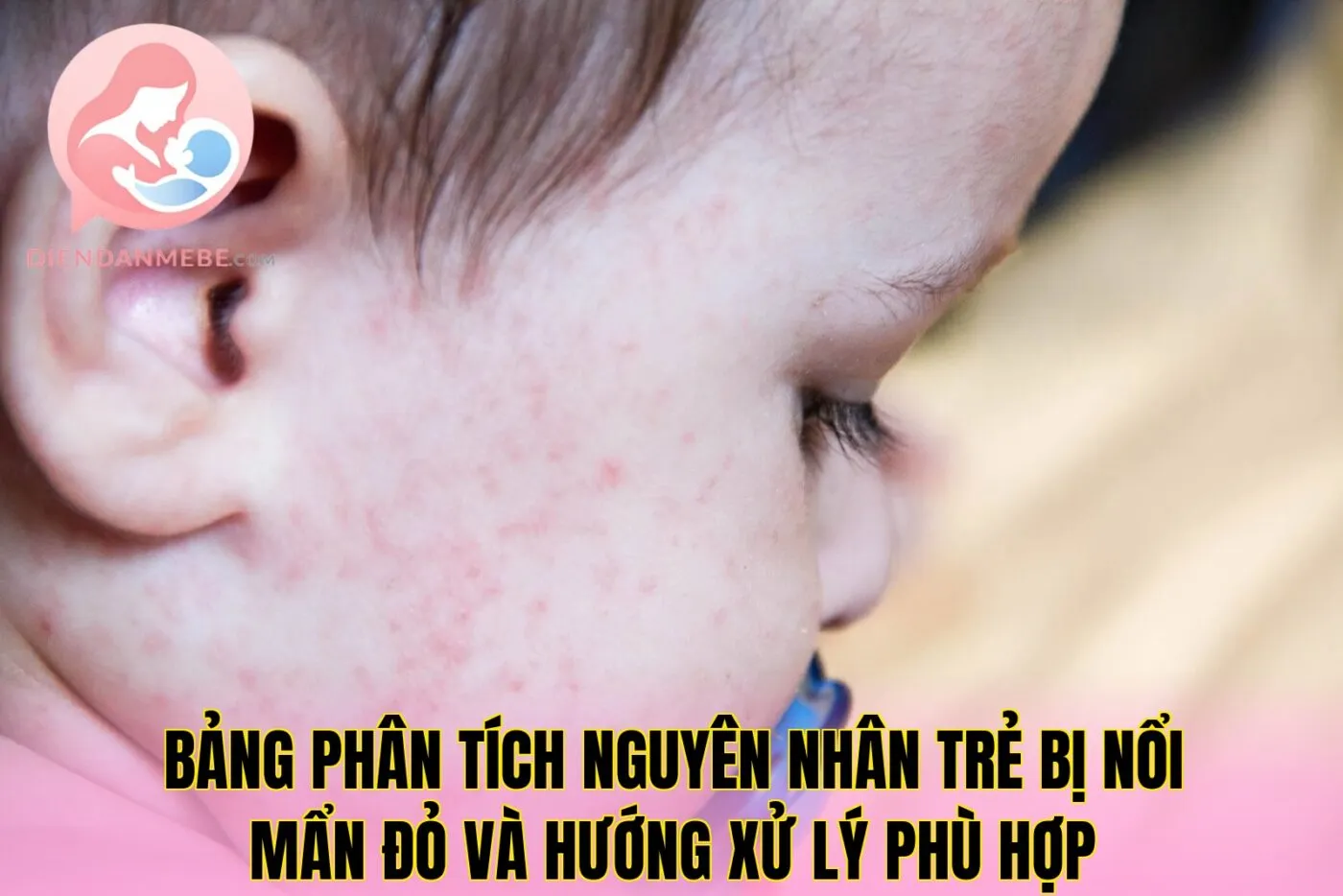 Bảng phân tích nguyên nhân trẻ bị nổi mẩn đỏ và hướng xử lý phù hợp