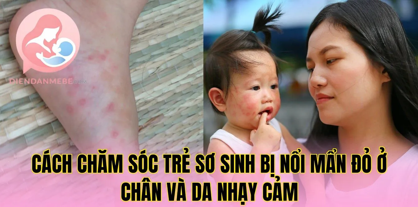 Cách chăm sóc trẻ sơ sinh bị nổi mẩn đỏ ở chân và da nhạy cảm