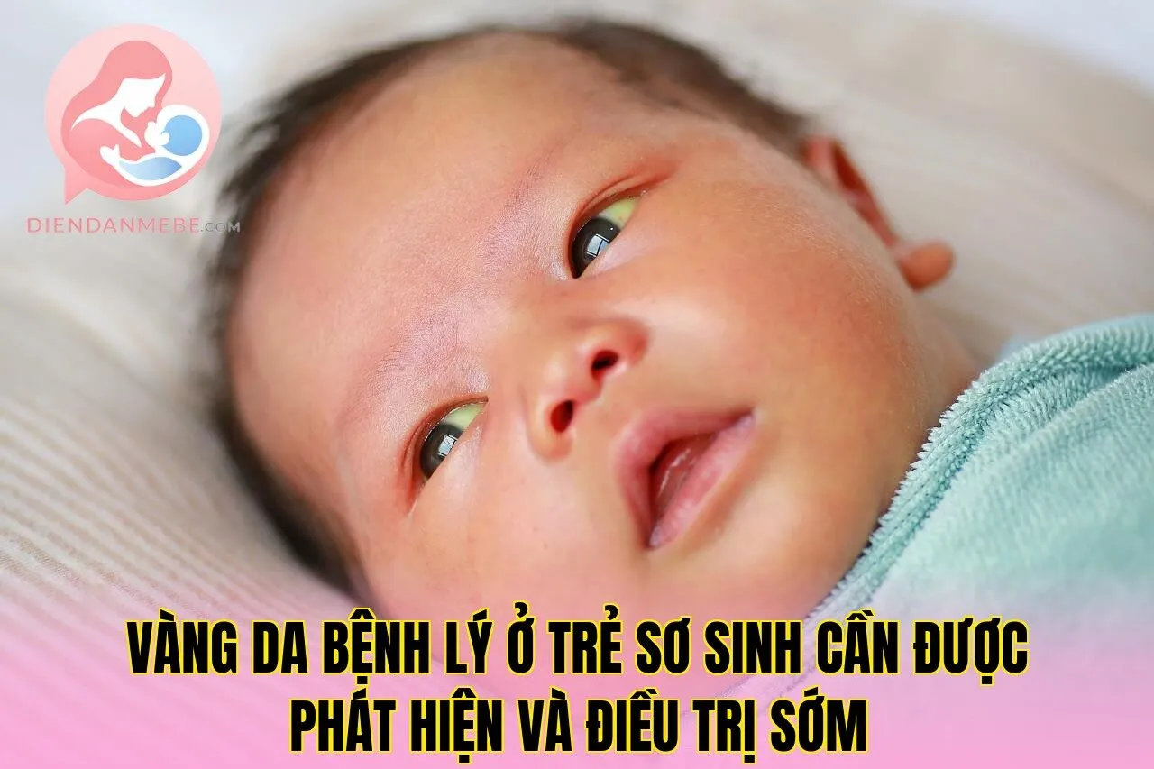 Vàng da bệnh lý ở trẻ sơ sinh cần được phát hiện và điều trị sớm