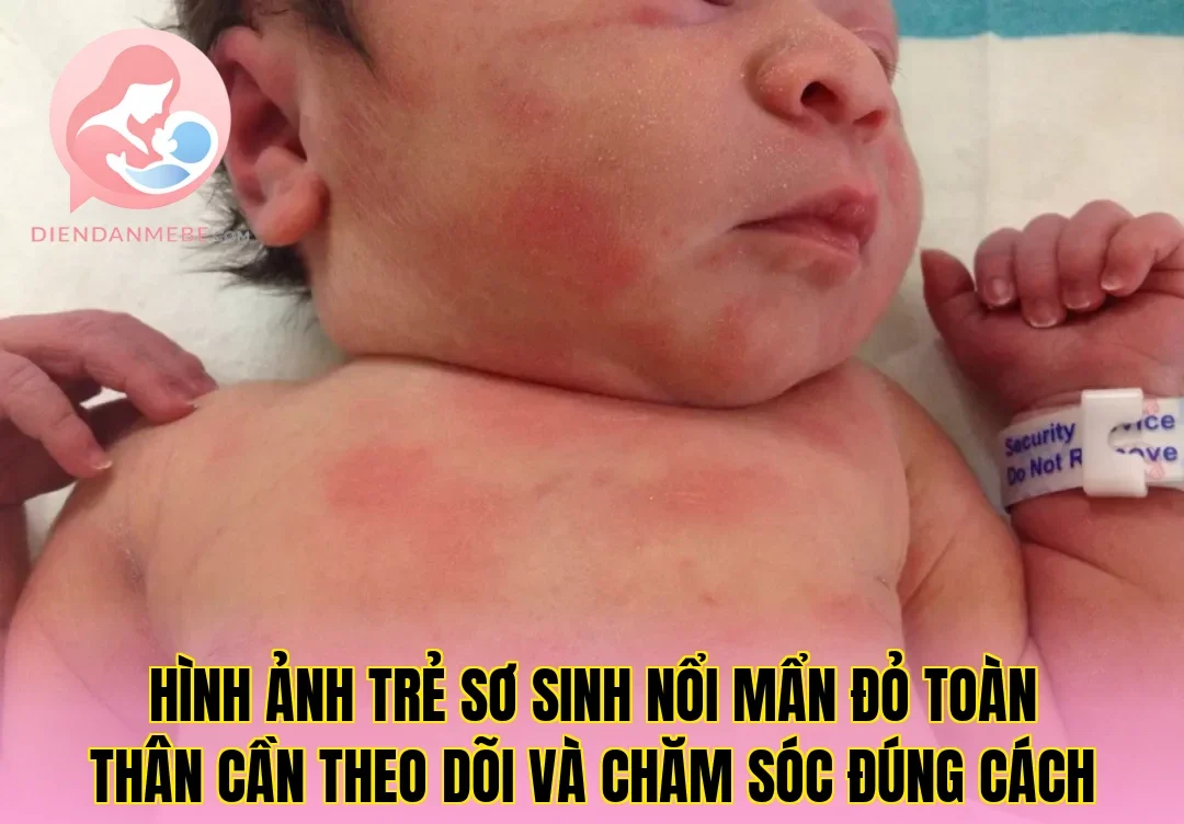 Hình ảnh trẻ sơ sinh nổi mẩn đỏ toàn thân cần theo dõi và chăm sóc đúng cách