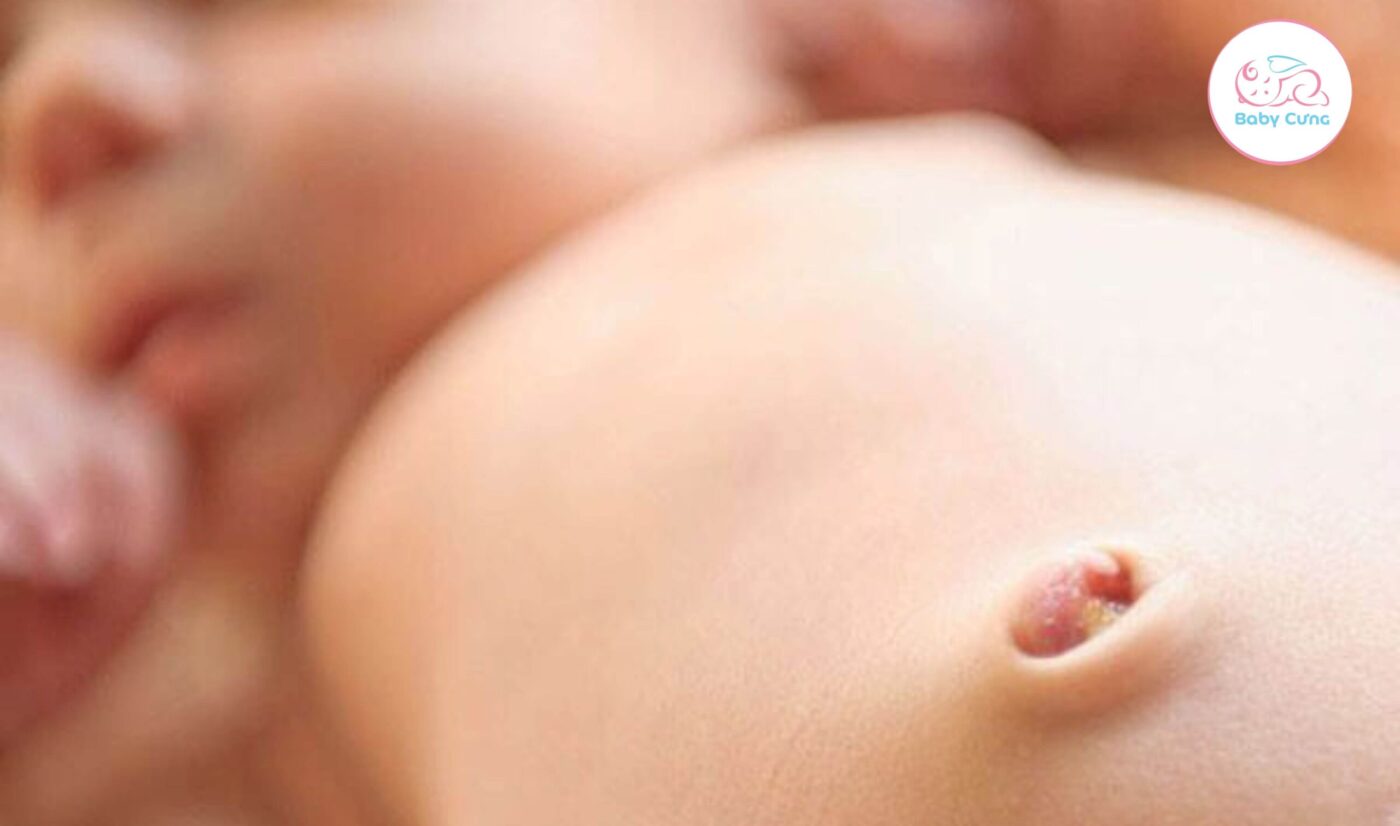 rốn em bé sơ sinh có mùi hôi